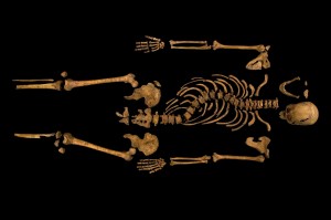 scoliosis-richard-III
